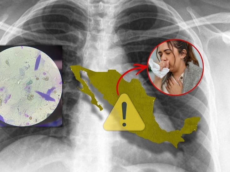 Aumenta la Tuberculosis en México este 2026 mientras el país enfrenta brote de sarampión: estos son los estados con más contagios y qué recomiendan las autoridades
