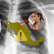 Aumenta la Tuberculosis en México este 2026 mientras el país enfrenta brote de sarampión: estos son los estados con más contagios y qué recomiendan las autoridades