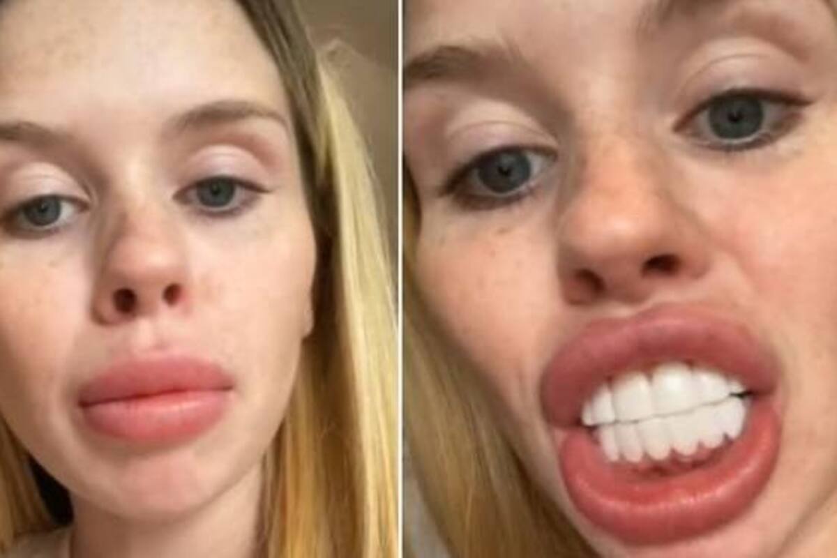 VIDEO: Joven se puso carillas dentales y alegó parecerse a un caballo