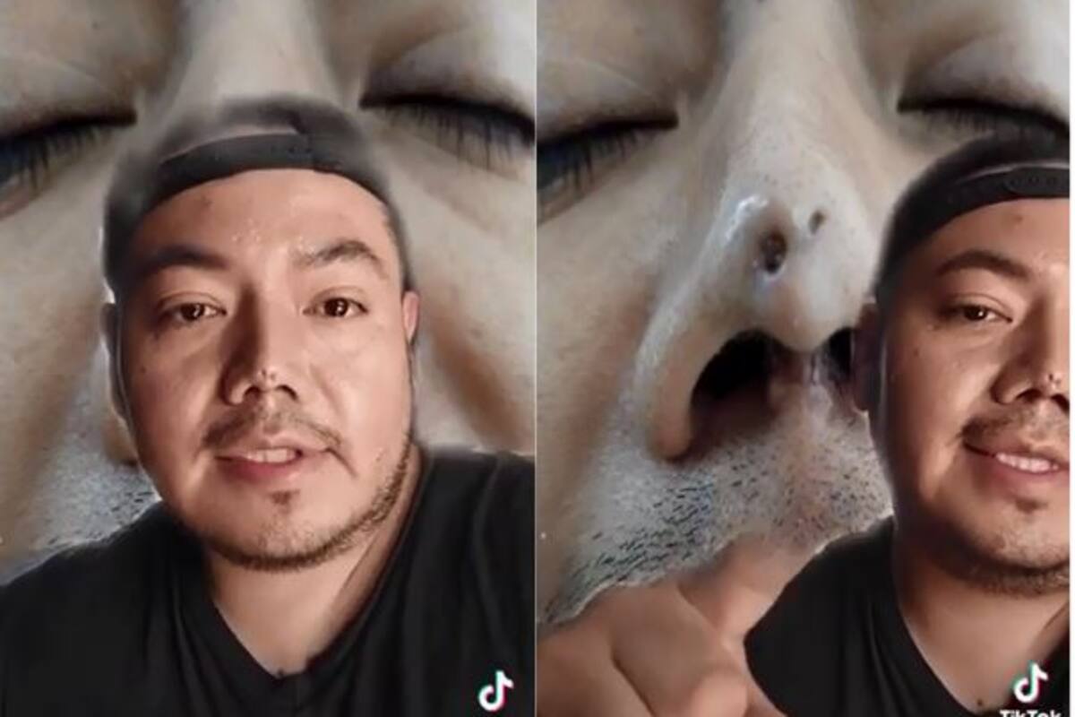 VIDEO: Joven denuncia que rinoplastia le provocó una necrosis; su cirujano era dentista