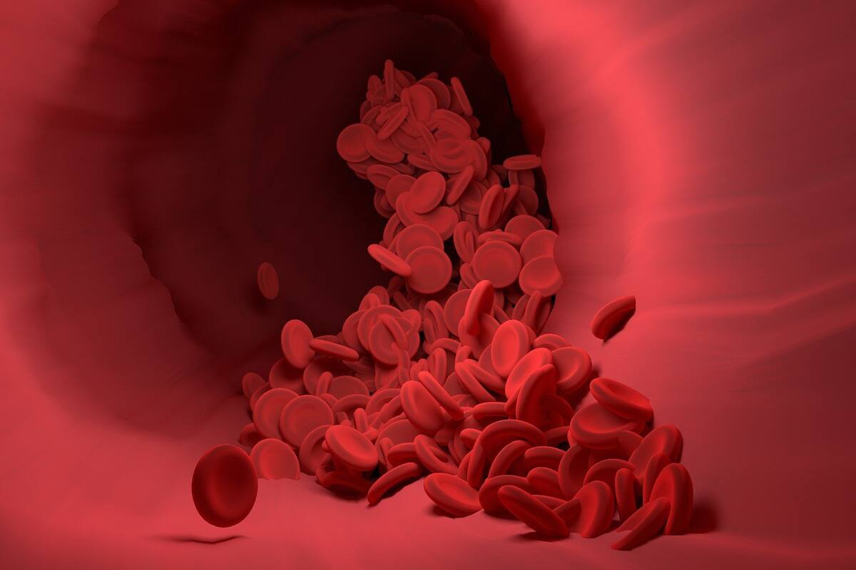 Los síntomas que se dan durante un episodio de coagulación de sangre