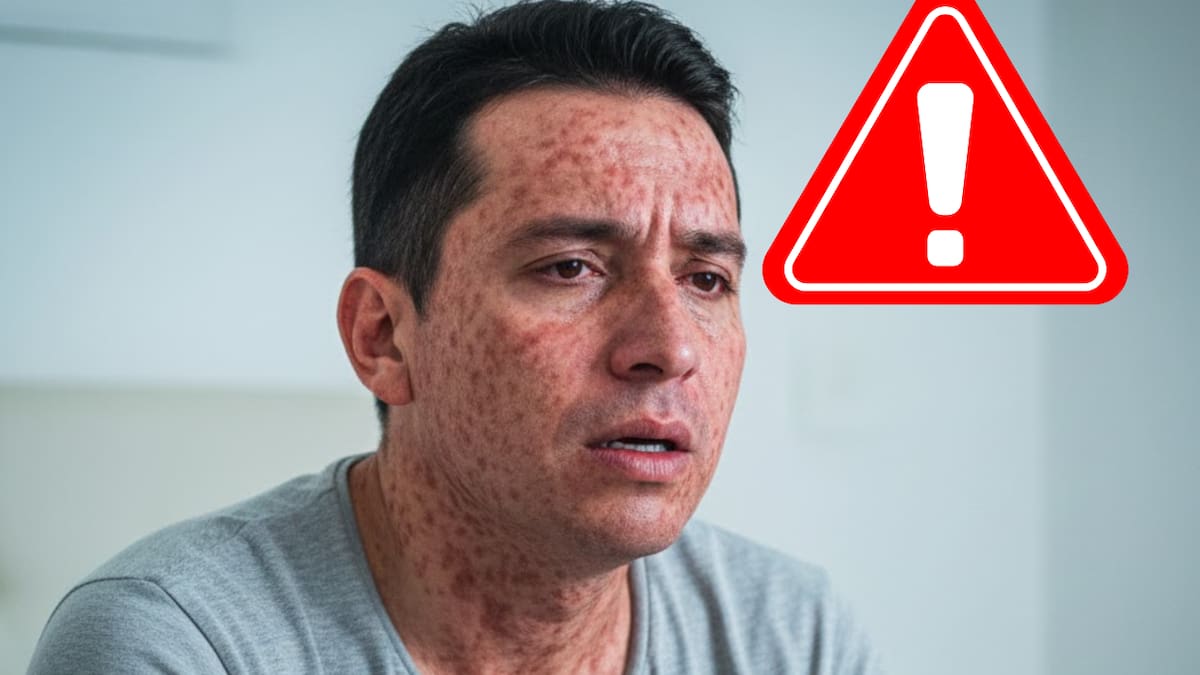 Más contagioso que el Covid-19: ¿Qué tan peligroso es el sarampión? El riesgo de un virus que “borra” la memoria inmunológica