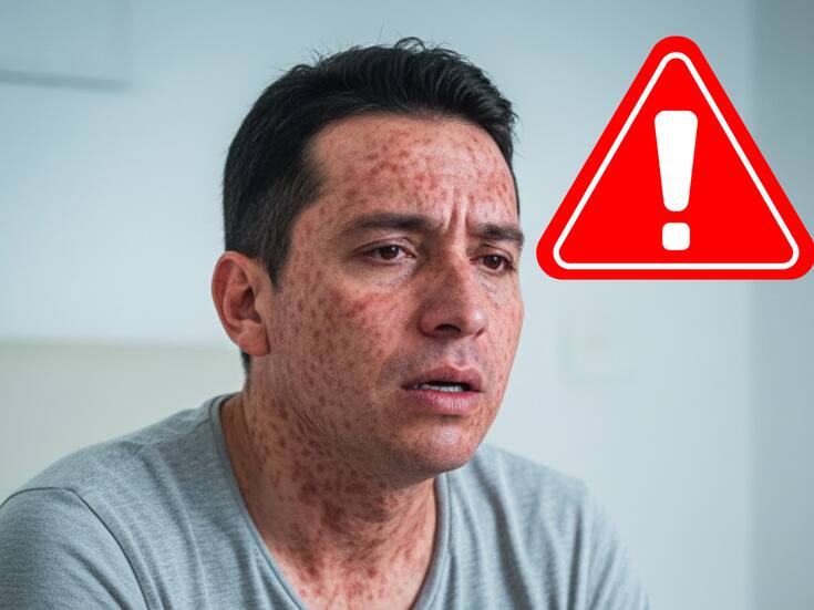 Más contagioso que el Covid-19: ¿Qué tan peligroso es el sarampión? El riesgo de un virus que “borra” la memoria inmunológica