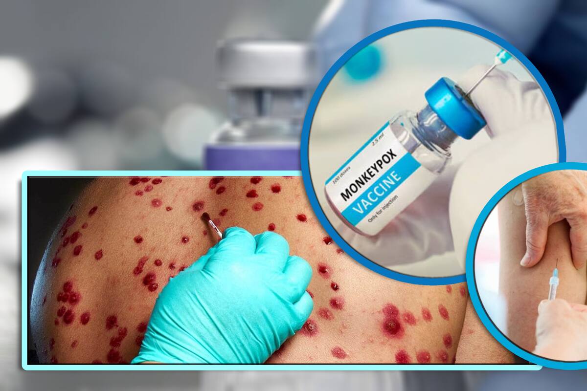 Detectan primer caso de mpox clado 1b en Francia en una mujer