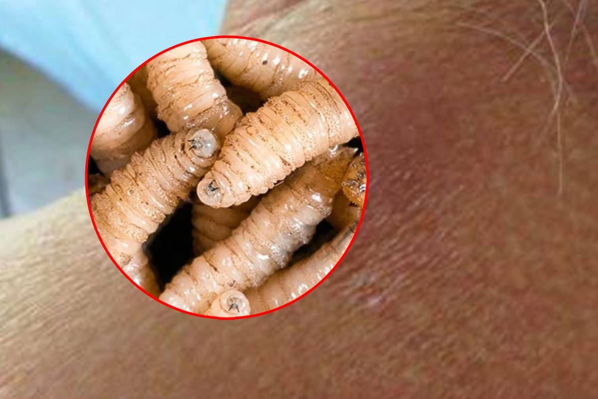 ¿Qué es la miasis? Primer caso por gusano barrenador en Chiapas alerta a México, cómo pueden brotarte gusanos de la piel