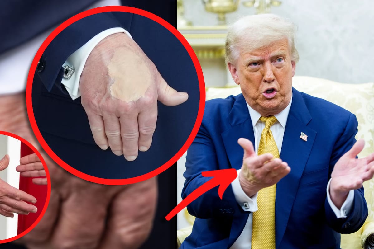 ¿Qué tiene Donald Trump en las manos? La Casa Blanca dice que usa maquillaje para cubrir moretones por “dar apretones de mano diariamente”