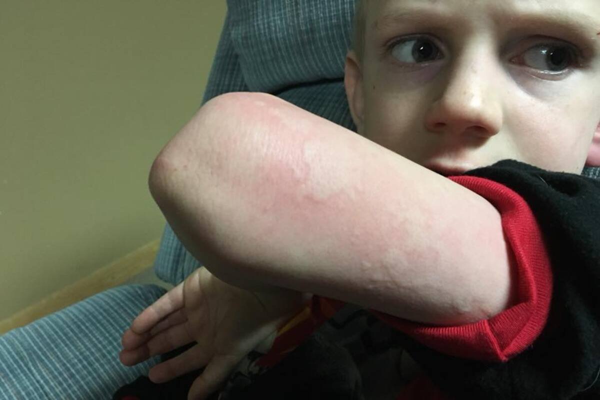 Madre alerta: Si su hijo presenta urticaria podría ser influenza