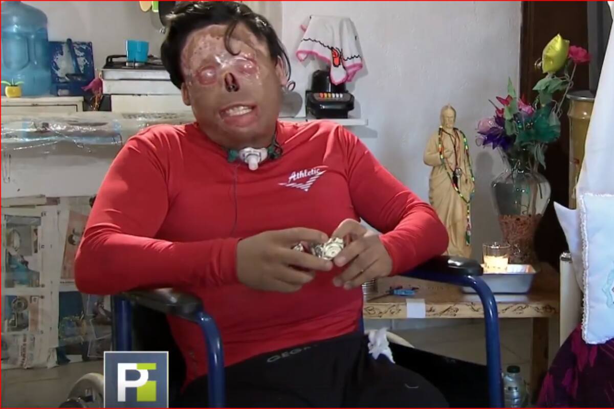 "Quiero un rostro para buscar a mi hijo": El deseo de Adán tras descarga eléctrica que quemó su cuerpo