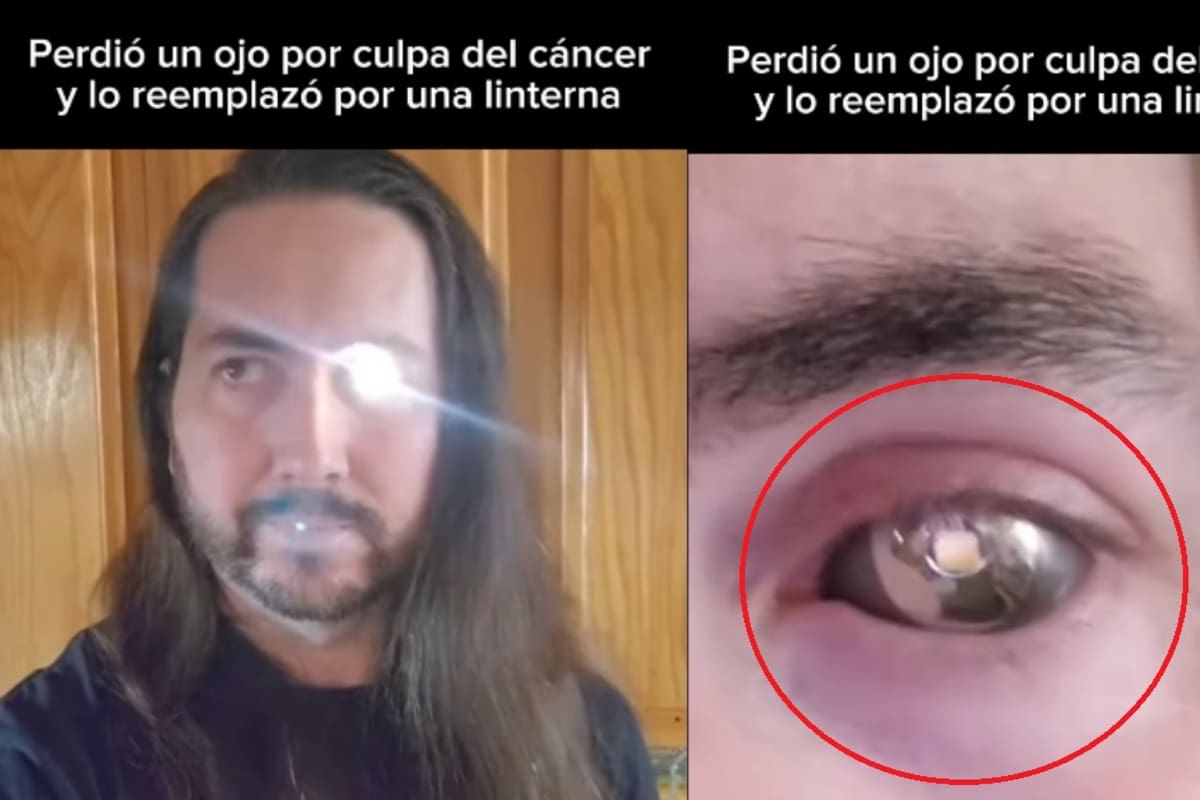 VIDEO: Hombre se vuelve viral al mostrar su ingenioso reemplazo tras perder un ojo por cáncer