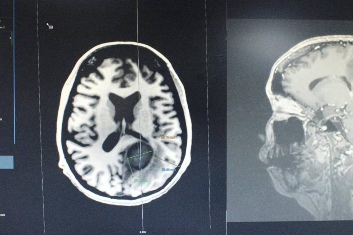 Médicos del ISSSTE retiran tumor cerebral del tamaño de un huevo a paciente