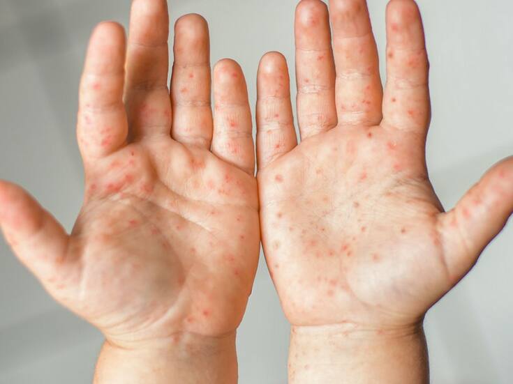 No habrá suspensión de clases en Mexicali por virus Coxsackie