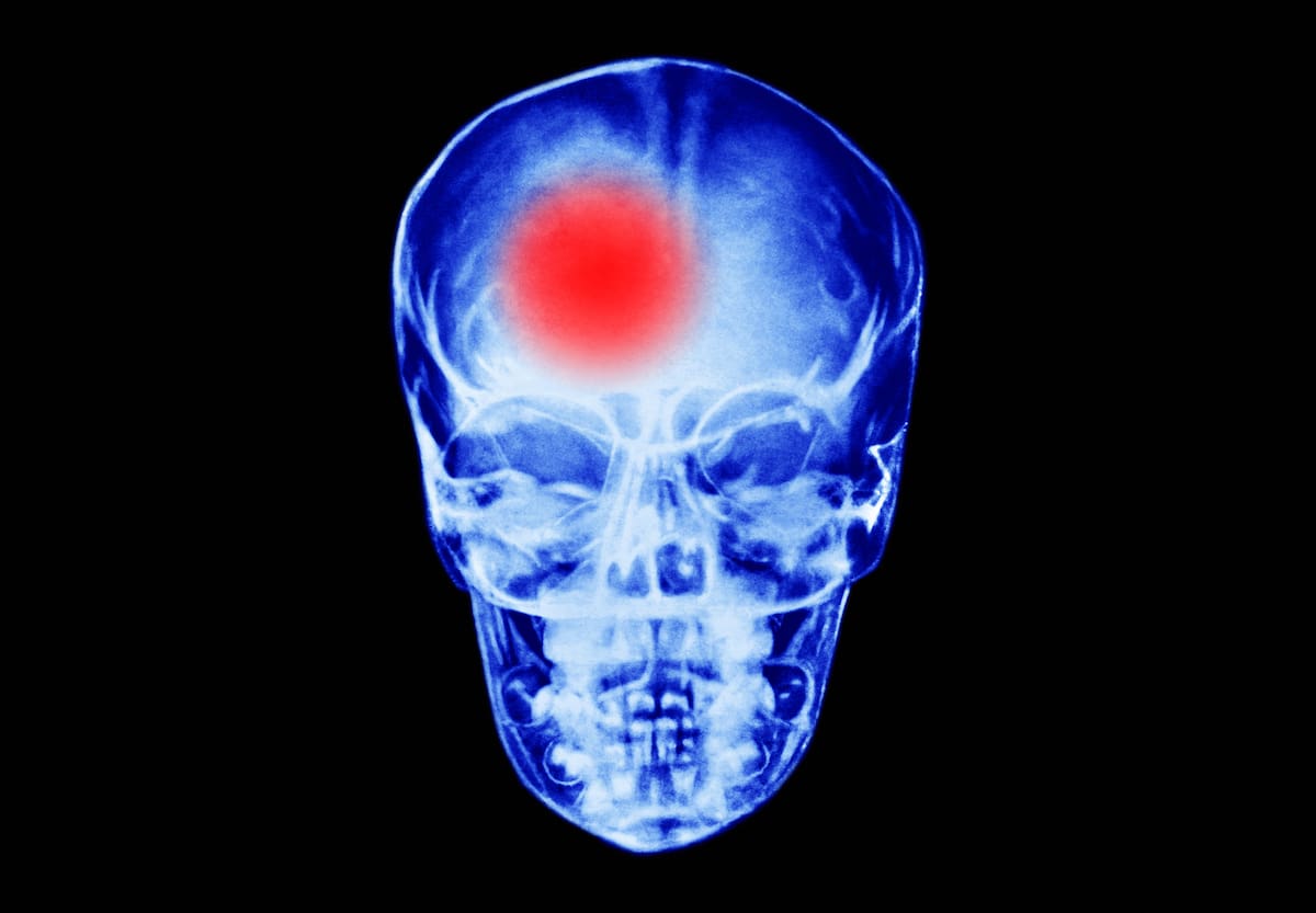 X-ray image of a skull show a red area