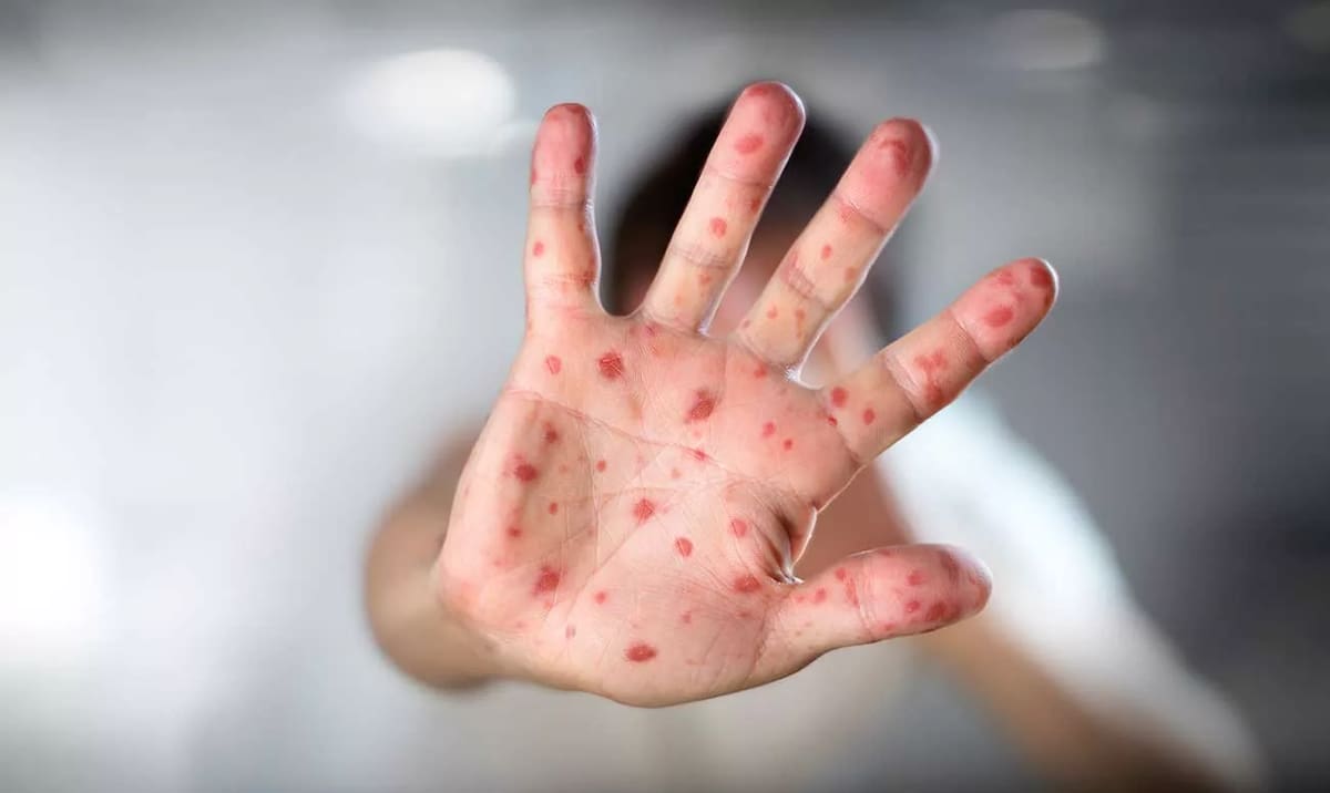 El sarampión es una enfermedad vírica muy contagiosa que afecta sobre todo a los niños. FOTO: BANCO DIGITAL GH