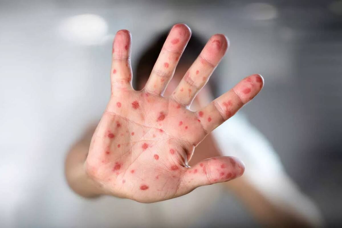 Lanza advertencia UNAM en México ante “resurgimiento” del sarampión