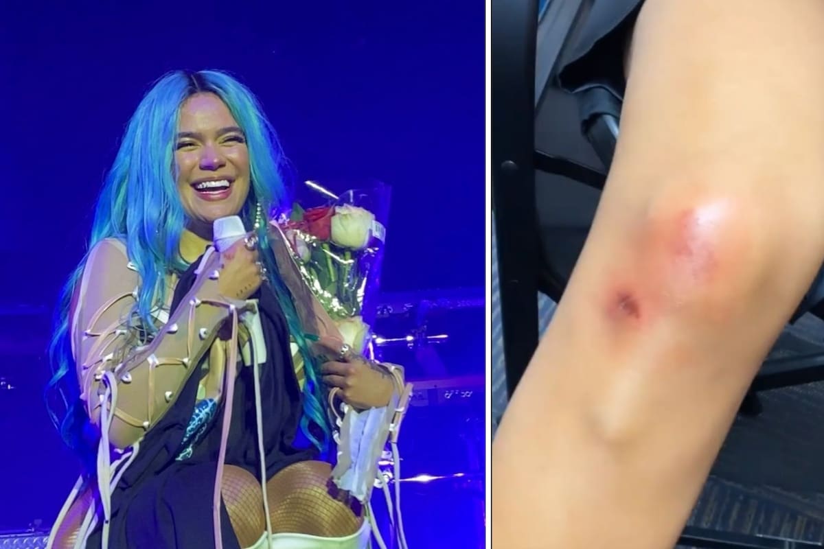 Así quedó Karol G después de su caída