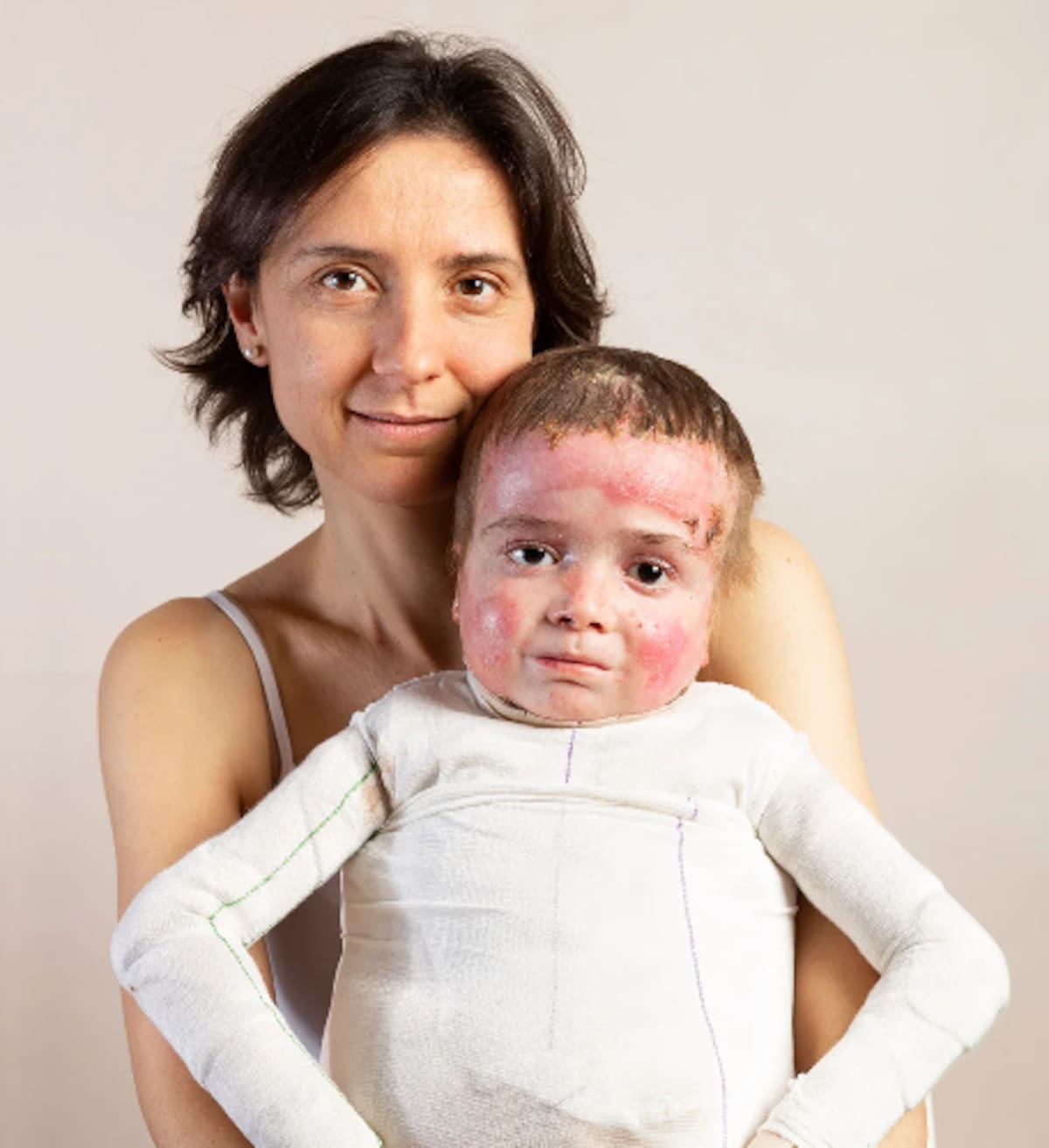 Paciente con Epidermólisis Bullosa
Fuente: pieldemariposa.es