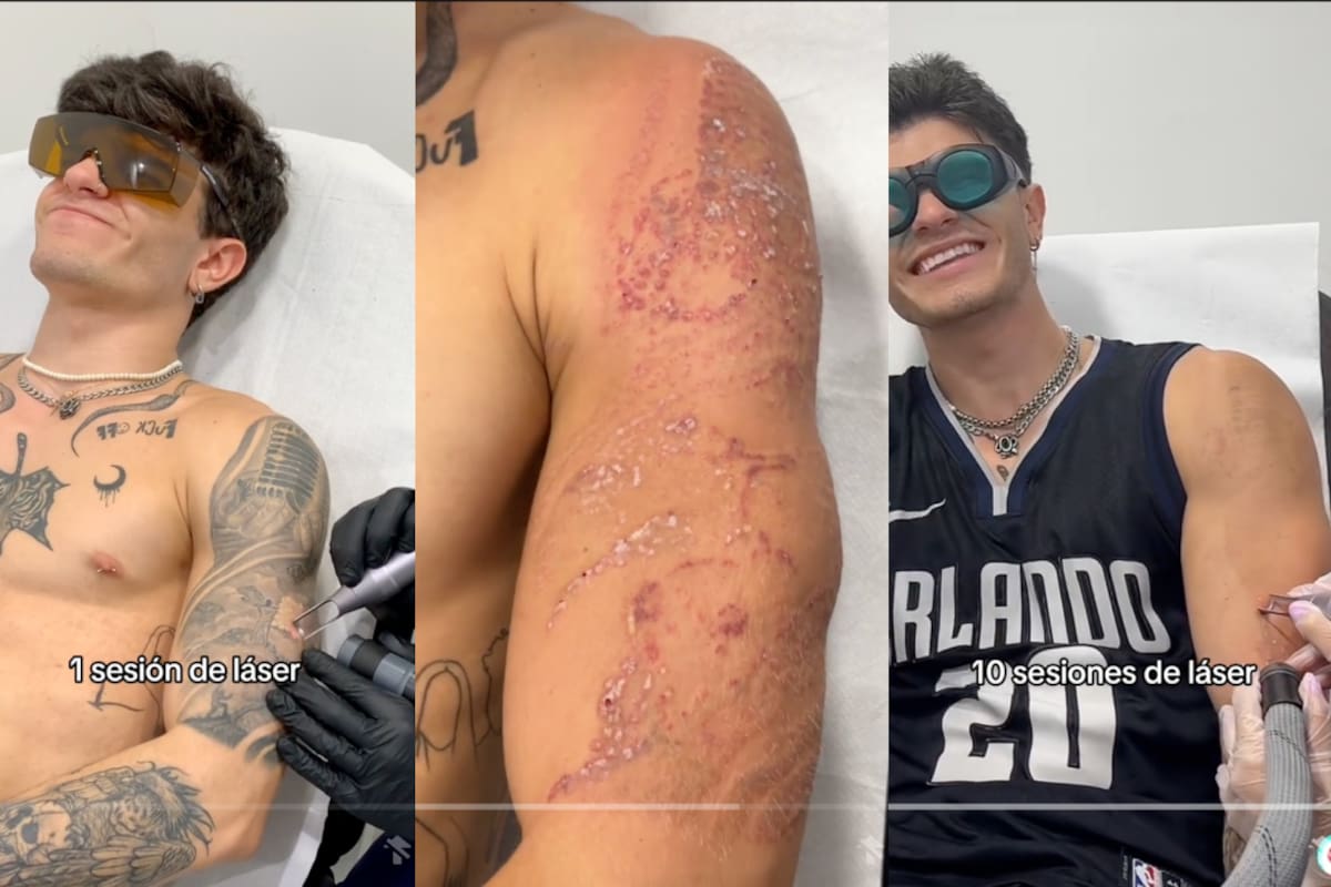 Joven muestra el doloroso proceso de quitarse un tatuaje con láser | VIRAL