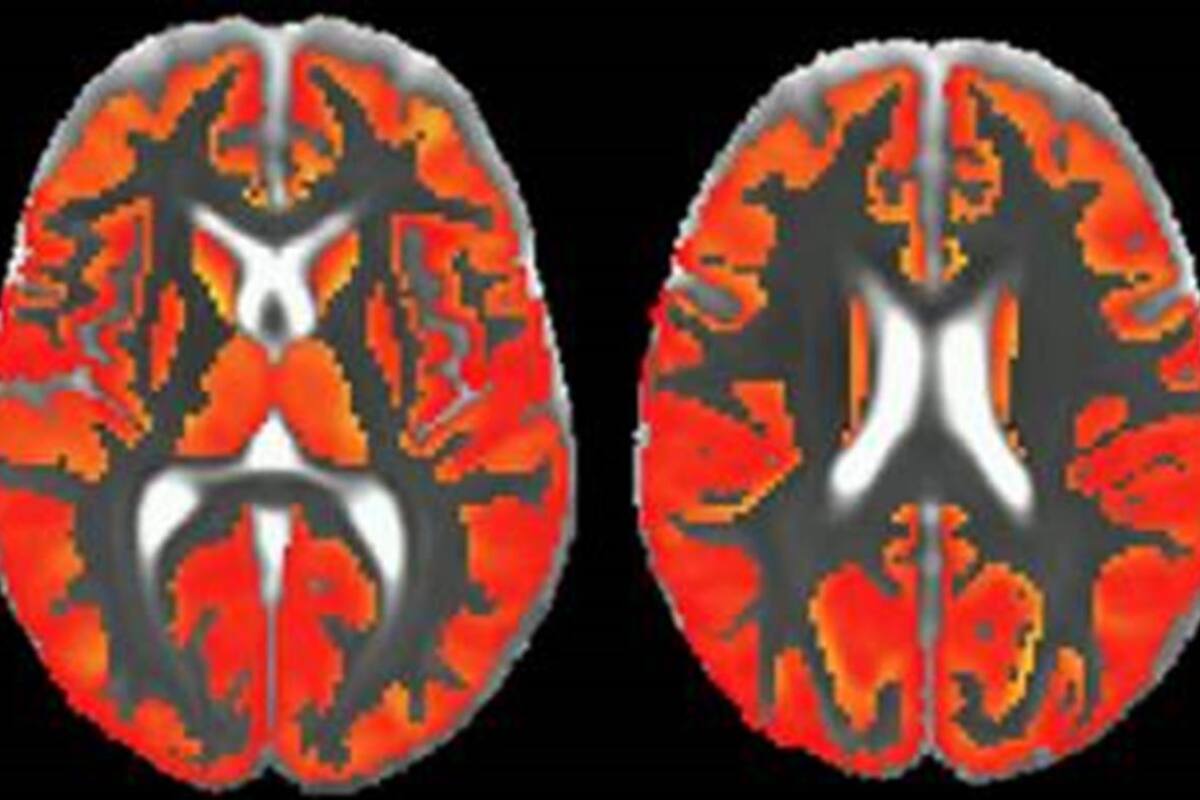Nueva resonancia permitirá anticipar las enfermedades neurodegenerativas