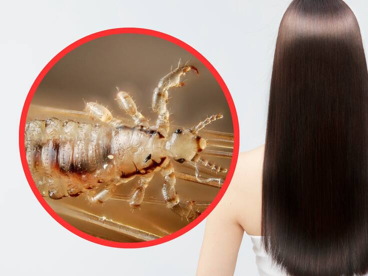 Piojos: qué son, cómo se contagian y por qué no tienen relación con la higiene
