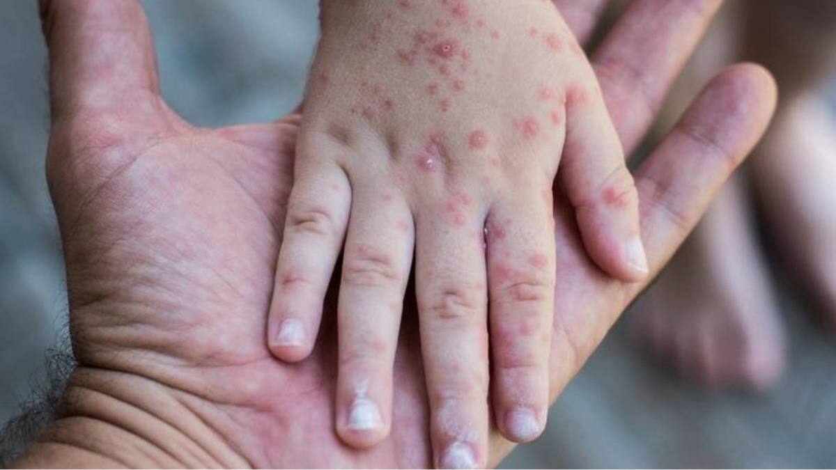 Aumento de casos importados de sarampión en México ha llevado a la Secretaría de Salud a emitir un aviso epidemiológico.
Foto: X de Jorge Fernández Menéndez
@J_Fdz_Menendez