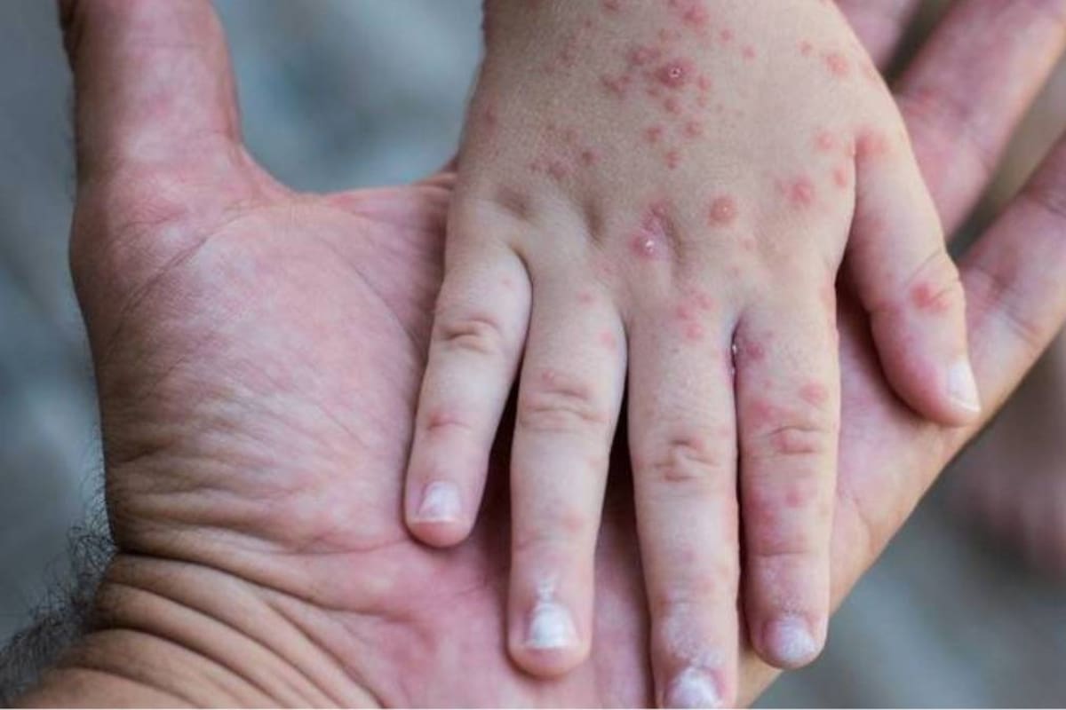 Sarampión avanza en México: 25 estados con contagios, 22 muertes y casi 5 mil casos; solo 6 estados libres de la enfermedad