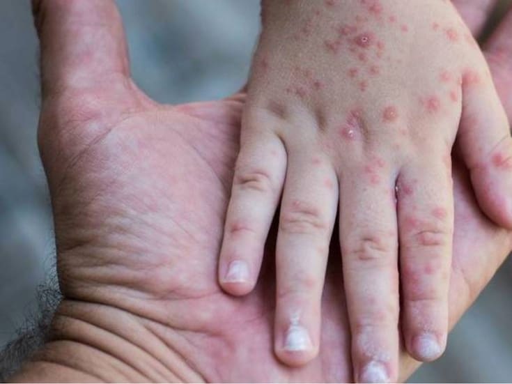Sarampión avanza en México: 25 estados con contagios, 22 muertes y casi 5 mil casos; solo 6 estados libres de la enfermedad