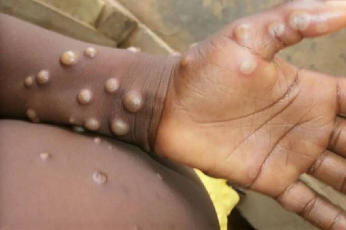 Viruela del mono: OMS reporta 384 muertes en RDC en lo que va del año