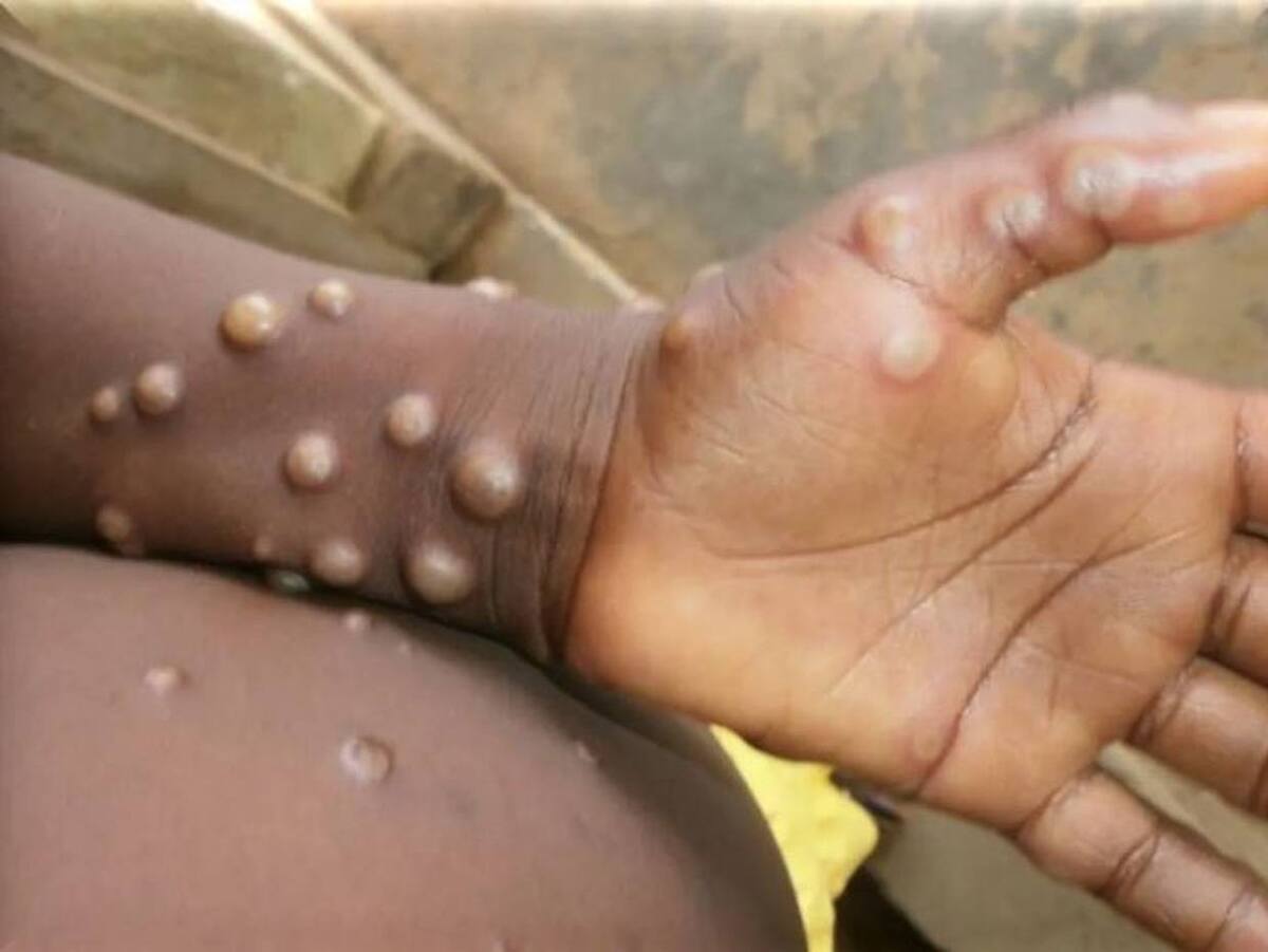 Viruela del mono: OMS reporta 384 muertes en RDC en lo que va del año / fotografía ilustrativa