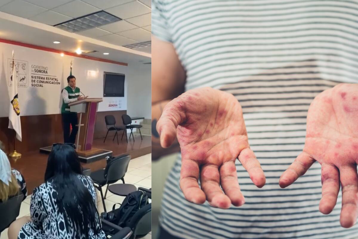Caso de sarampión en Sonora: Se encuentra estable, en recuperación y sin complicaciones graves