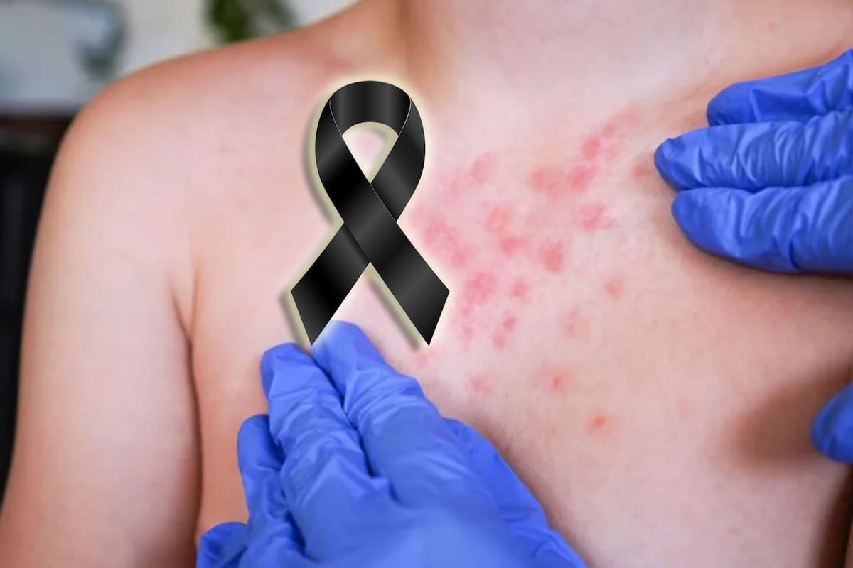 Murió bebé de un año por sarampión en México tras complicaciones ya que no estaba vacunado