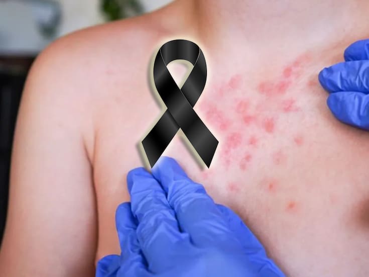 Murió bebé de un año por sarampión en México tras complicaciones ya que no estaba vacunado