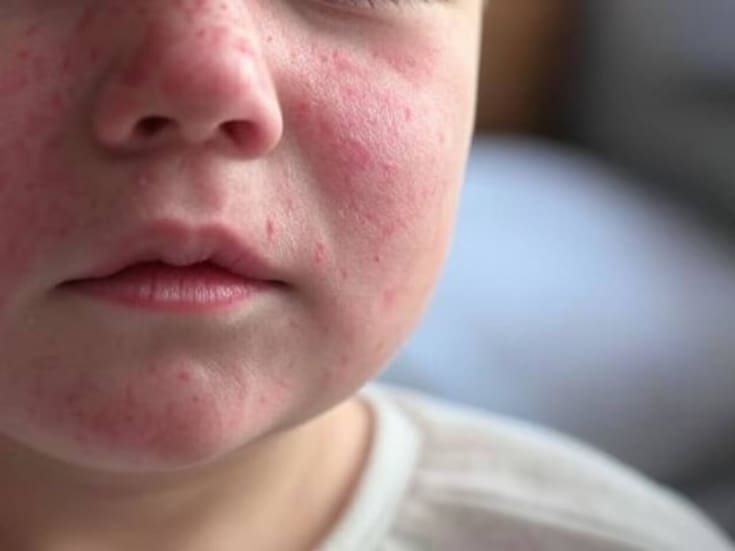 Baja California registra seis casos confirmados de sarampión