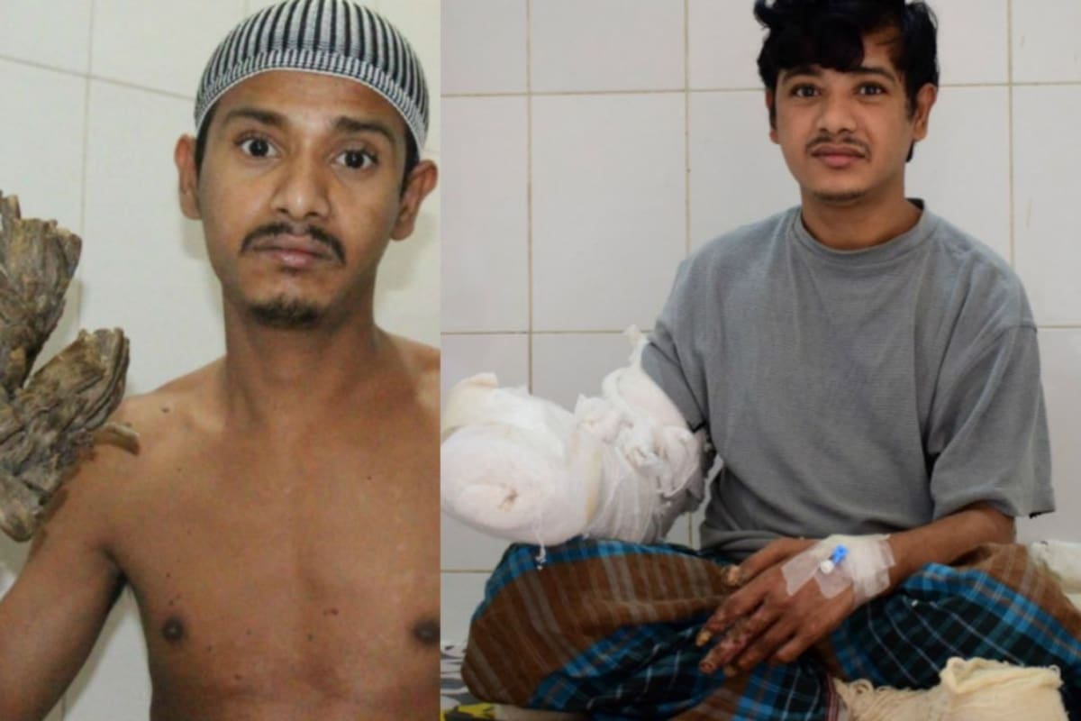 Descubre la impactante historia del “Hombre Árbol” y su increíble lucha por sobrevivir