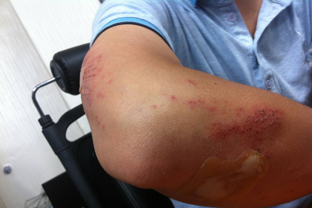 Aumentan accidentes en casa durante pandemia, sobre todo en menores: CRUM
