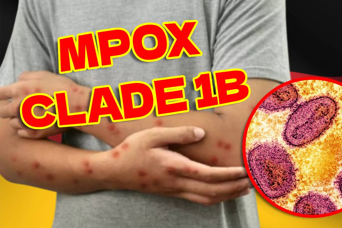 Reportan en Alemania un caso de la nueva variante “Clade 1B” de Mpox, lo cual significa un posible segundo rebrote en Europa