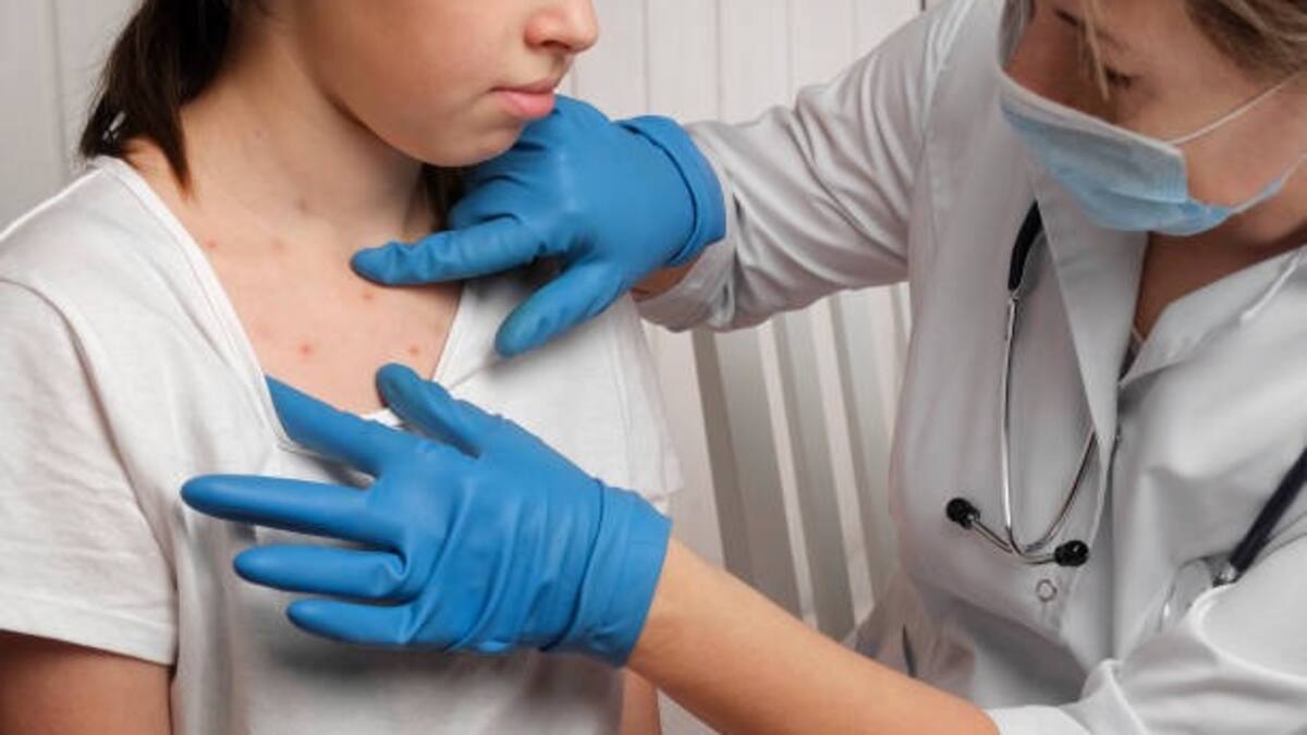 Aumentan los casos de sarampión en Baja California