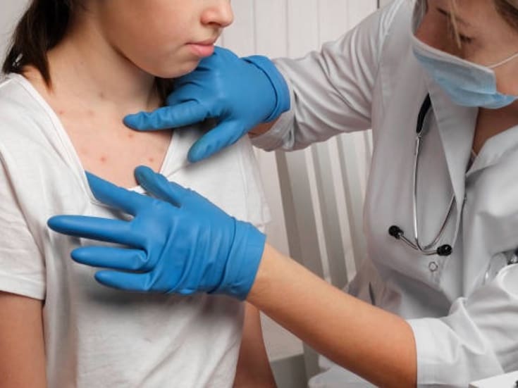 Aumentan los casos de sarampión en Baja California