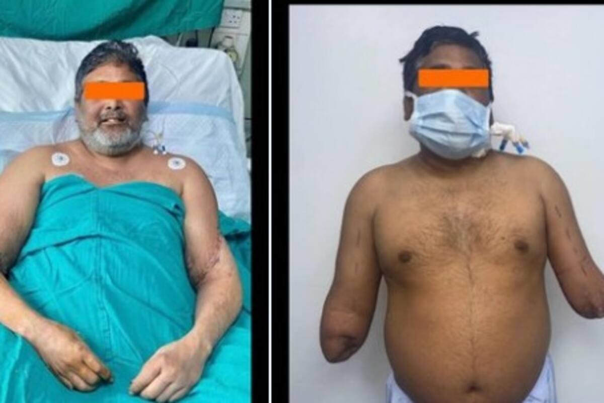 India: Pintor pierde sus manos y una mujer le dona las suyas