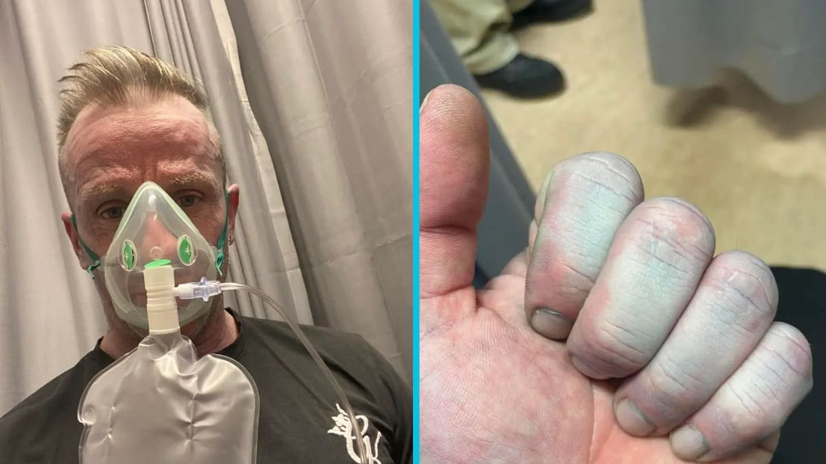 Un obrero en Inglaterra despierta con la piel azul, es trasladado a urgencias de un hospital y los médicos no encuentran ninguna enfermedad: la explicación detrás del extraño caso