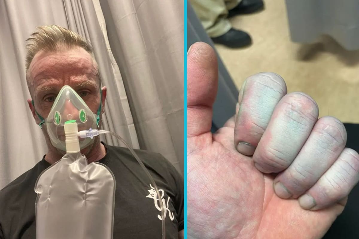 Un obrero en Inglaterra despierta con la piel azul, es trasladado a urgencias de un hospital y los médicos no encuentran ninguna enfermedad: la explicación detrás del extraño caso