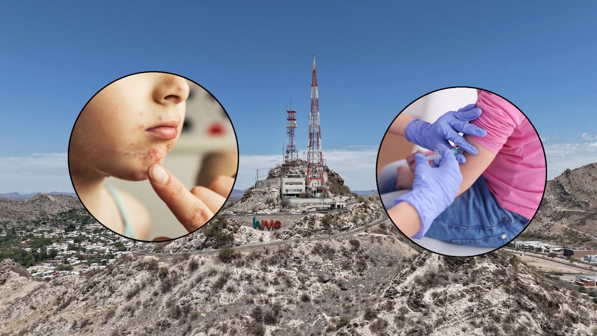 Suspenden clases en Secundaria Técnica 72 por brote de varicela en Hermosillo