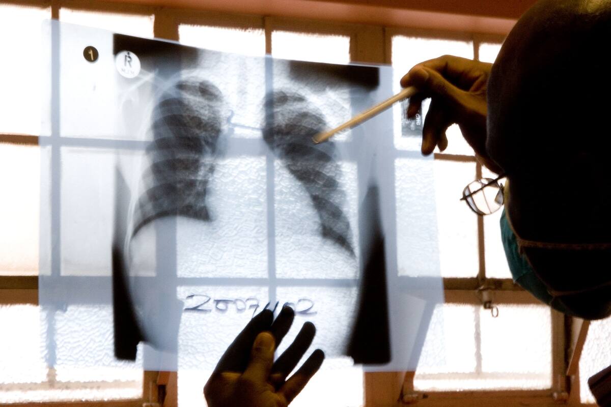 Van 600 casos de tuberculosis en lo que va del año
