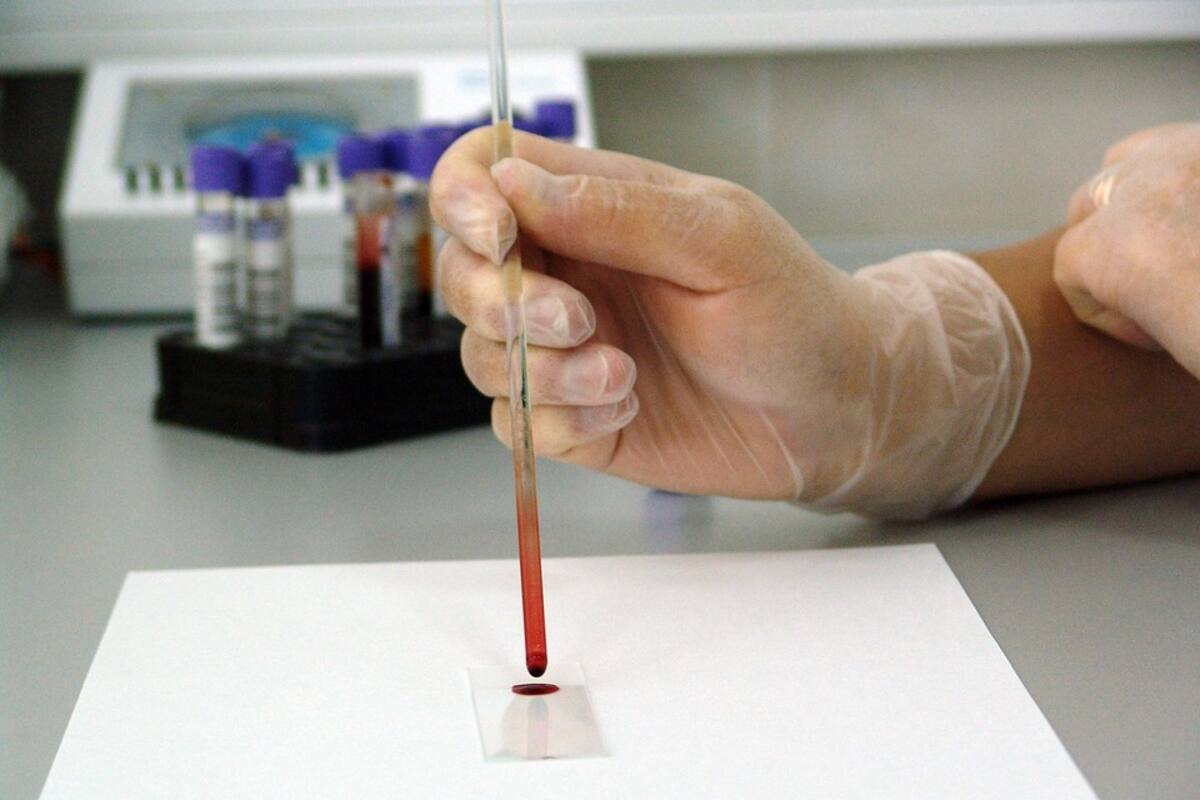 Nuevo análisis de sangre podría detectar el cáncer de mama 5 años antes de los síntomas