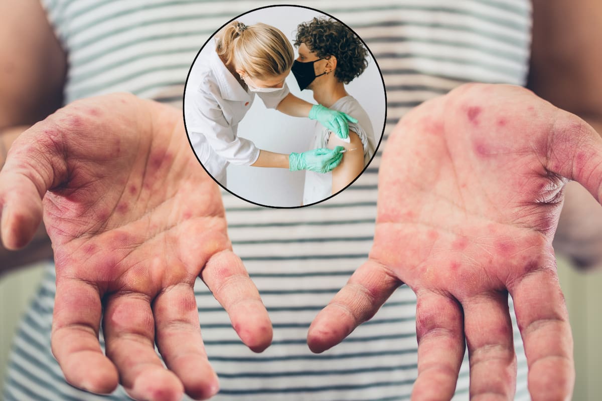 Mantienen jornada de vacunación en comunidades donde hubo brote de sarampión