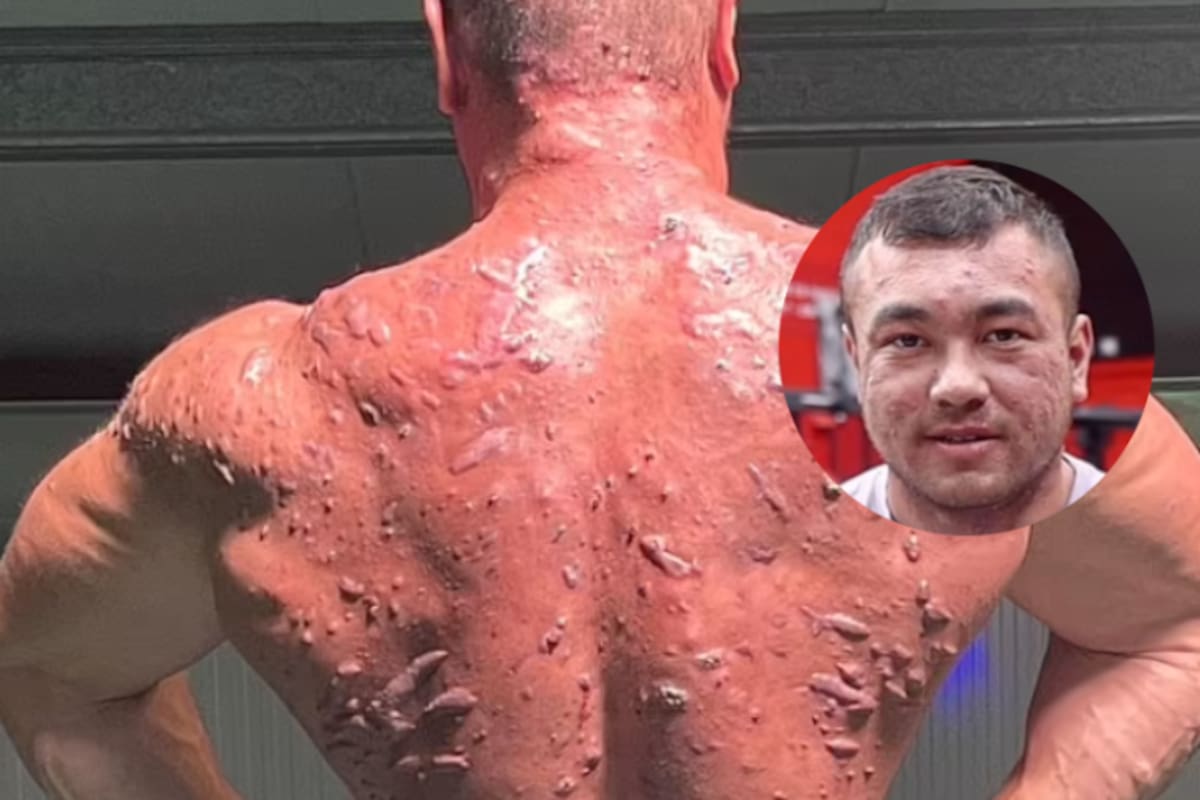 FOTOS: Fisicoculturista cuenta cómo usar esteroides le dejó acné, cicatrices y forúnculos