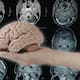 Científicos descubren que enfermedades cerebrales comparten factores de riesgo y se pueden prevenir a la vez: Estos son 17 FACTORES que afectan al mismo tiempo el riesgo de demencia, depresión y accidente cerebrovascular