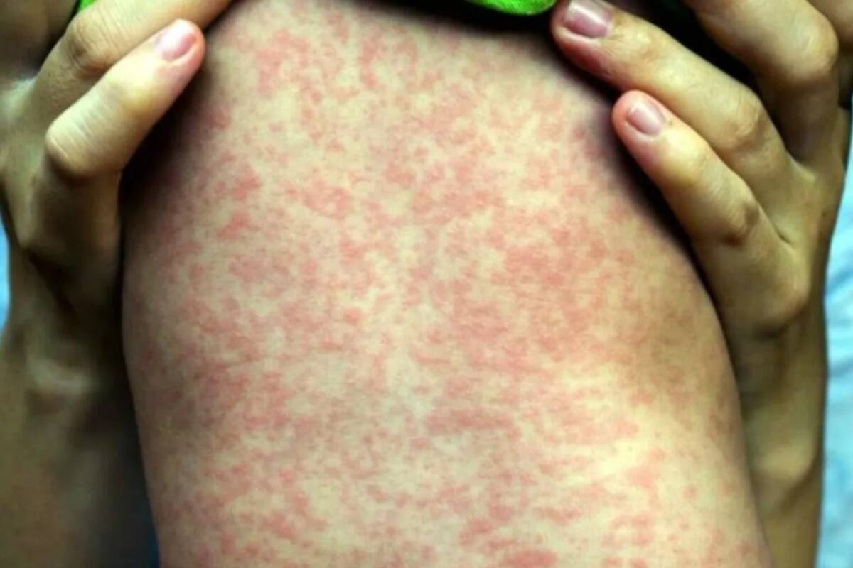 OMS alerta sobre nuevos brotes de sarampión