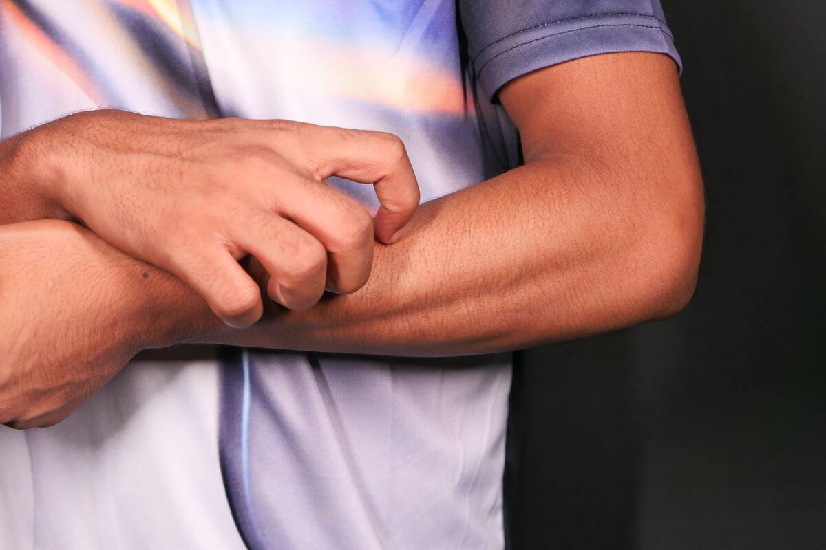 Alerta por calor y salud de la piel: qué es el sarpullido por calor y cómo prevenirlo