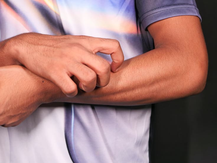 Alerta por calor y salud de la piel: qué es el sarpullido por calor y cómo prevenirlo