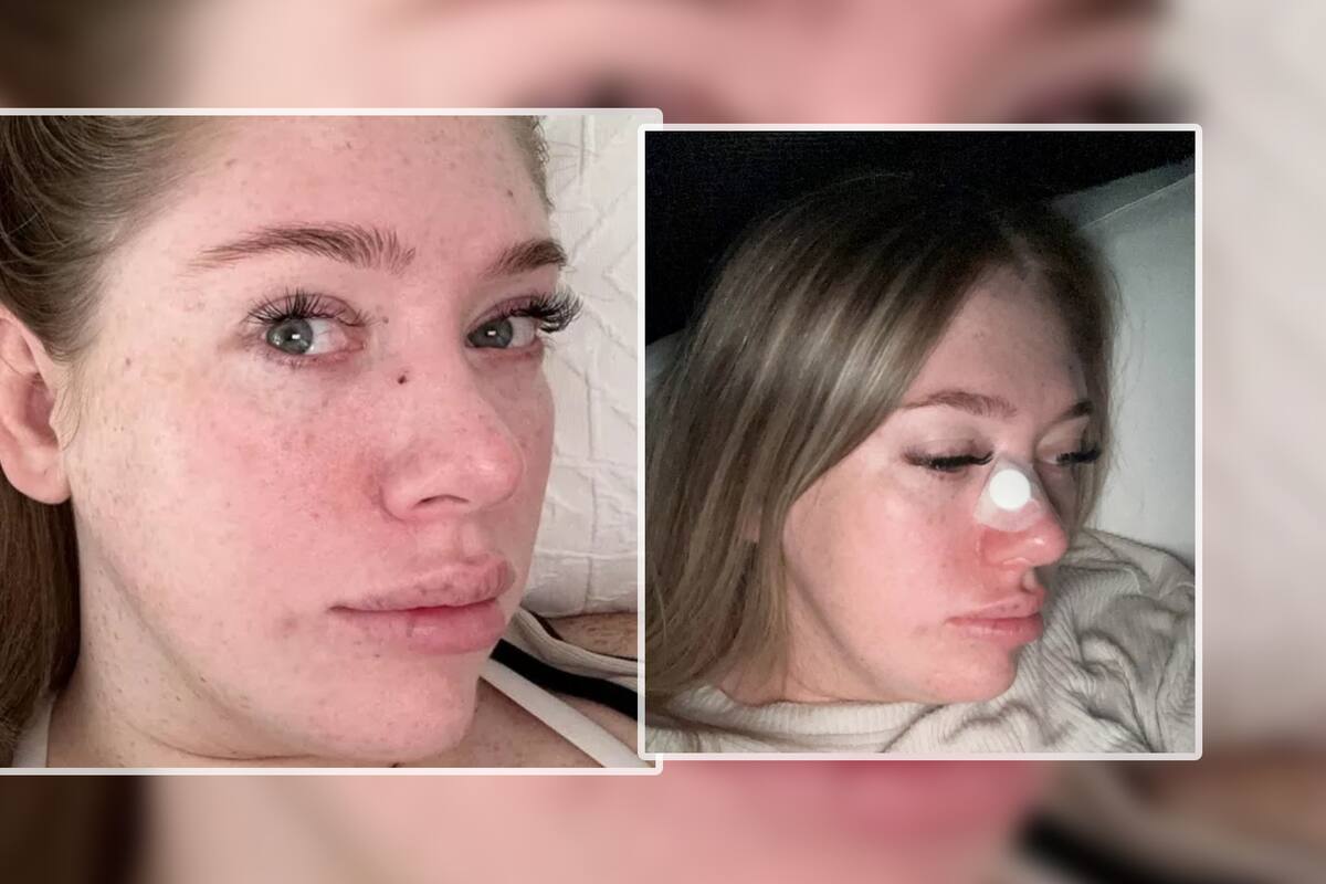 Creía que tenía un poro tapado, pero resultó ser cáncer de piel: Joven madre advierte sobre esta práctica tan común que le cambió la vida